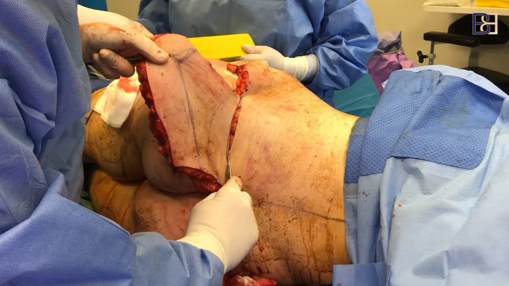 Buttock Lift Tissue Excision