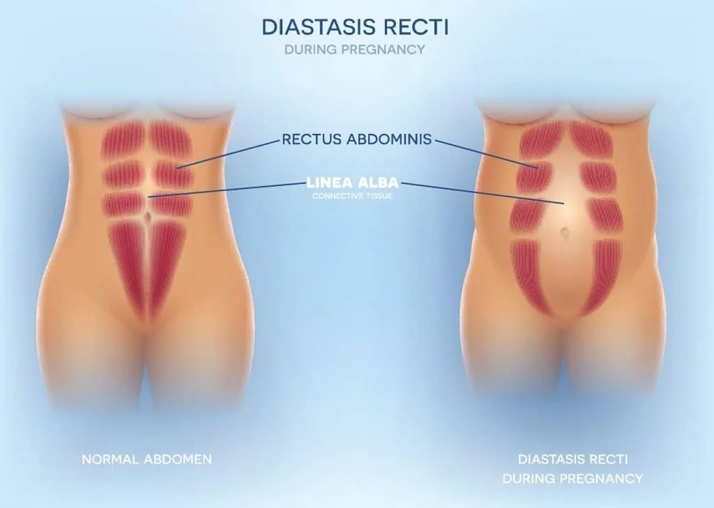 Diastasis Recti During Pregnancy