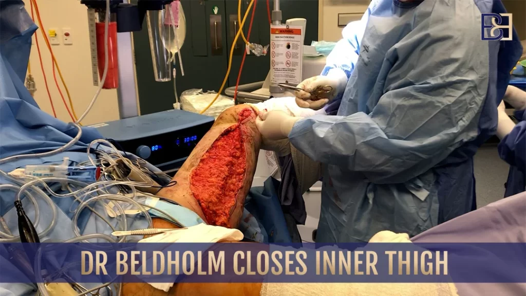 Dr. Beldholm closes inner thigh skin incision