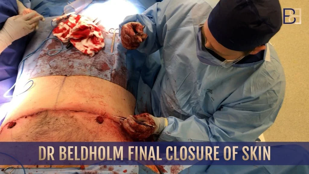 Dr. Beldholm final closure of skin