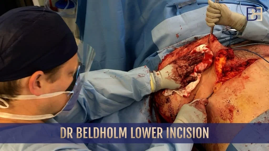 Dr. Beldholm lower incision