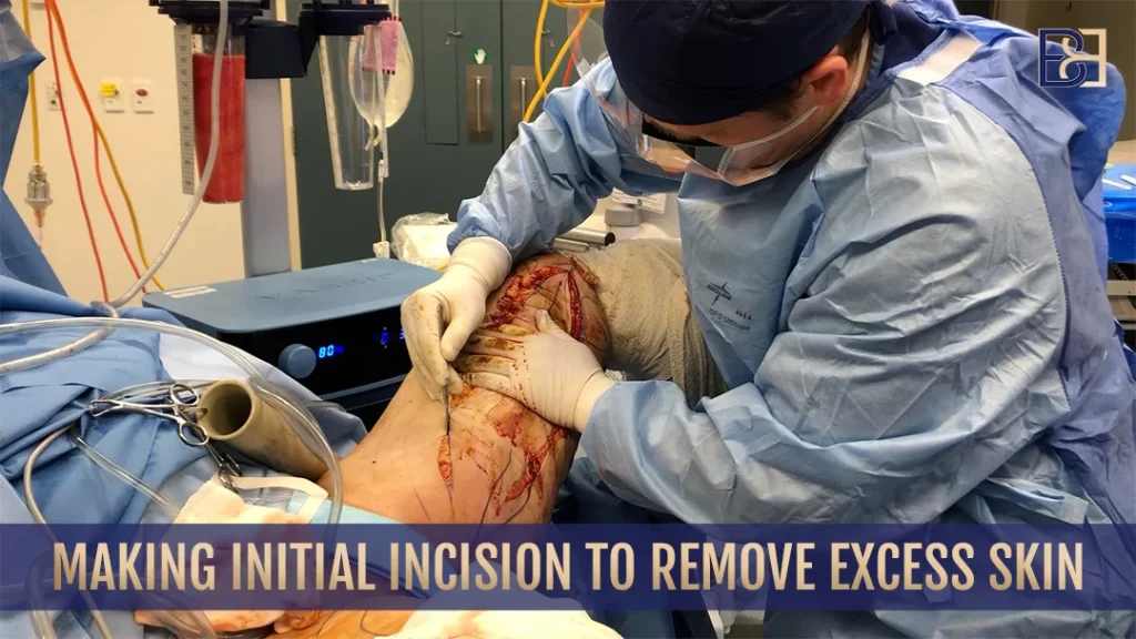 Dr. Beldholm making initial incision to remove excess skin