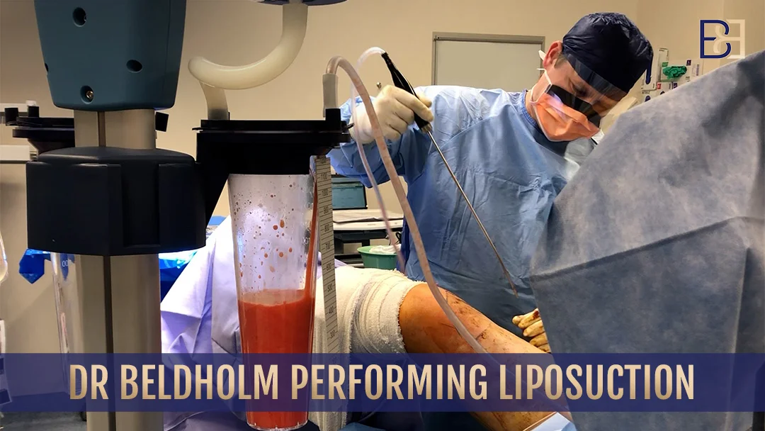 Dr. Beldholm performing liposuction