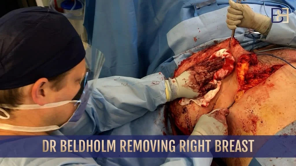 Dr. Beldholm removing right breast