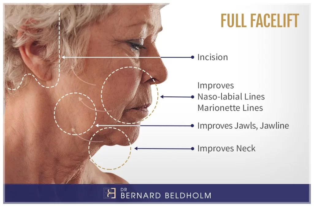 Dr. Bernard Beldholm Full Facelift Explanatory Image