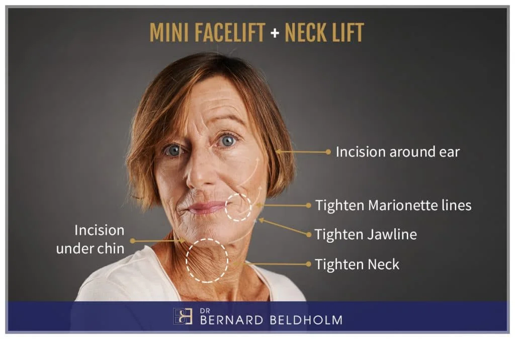 Dr. Bernard Beldholm Mini facelift Neck lift Explanatory Image