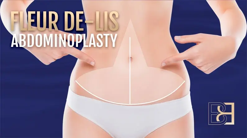 Fleur-De-Lis Abdominoplasty Following Massive Weight Loss