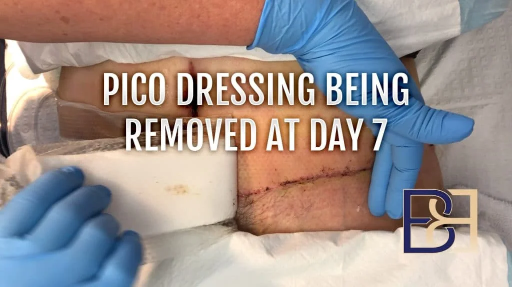 PICO dressing being removed at day 7