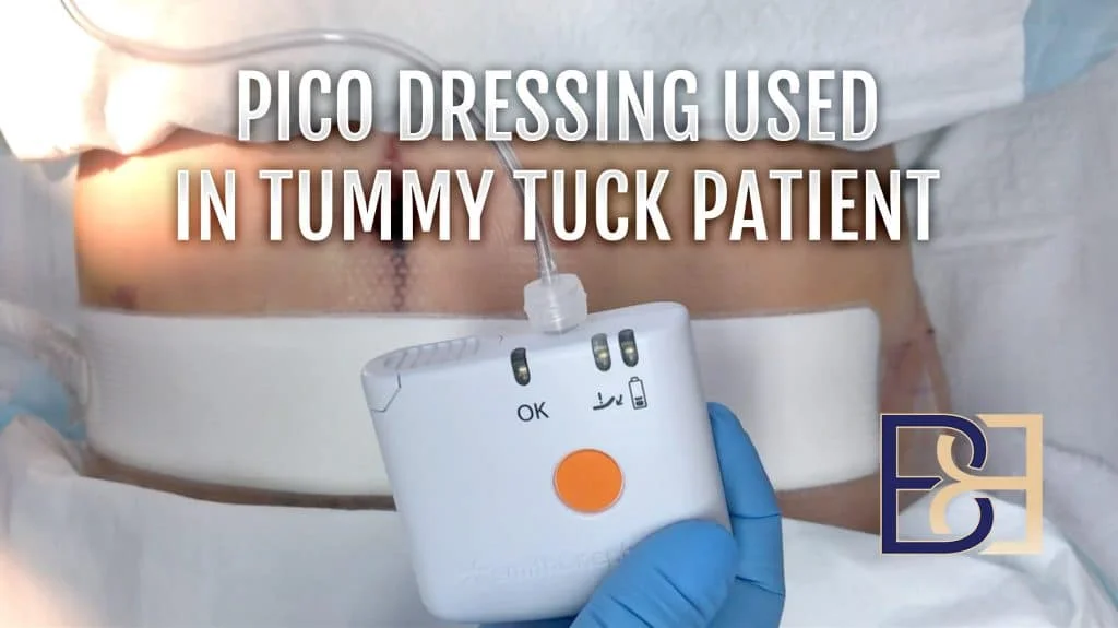 PICO dressing used in Tummy tuck patient