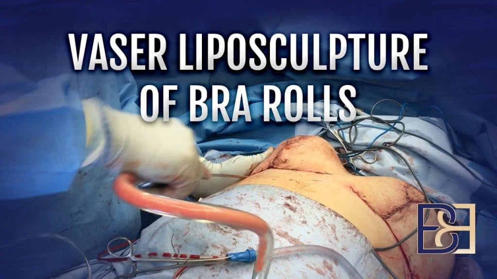 Patient 2016 4000 - Breast Reduction VASER Liposculpture of bra rolls