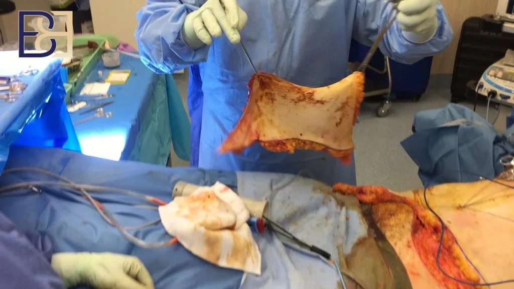 Skin removed with tummy tuck