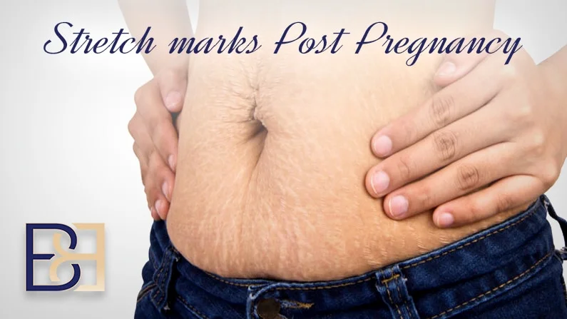 Stretch marks post pregnancy