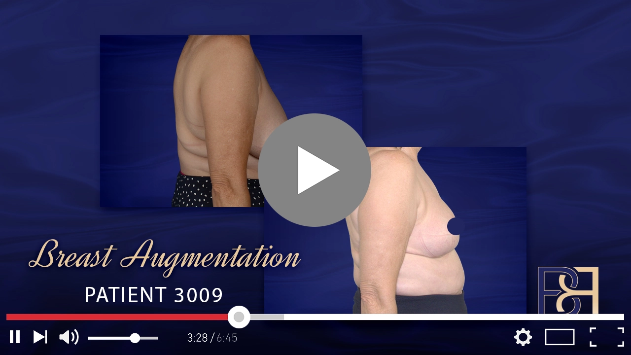 Patient 3009 - Breast Augmentation - Featured Image