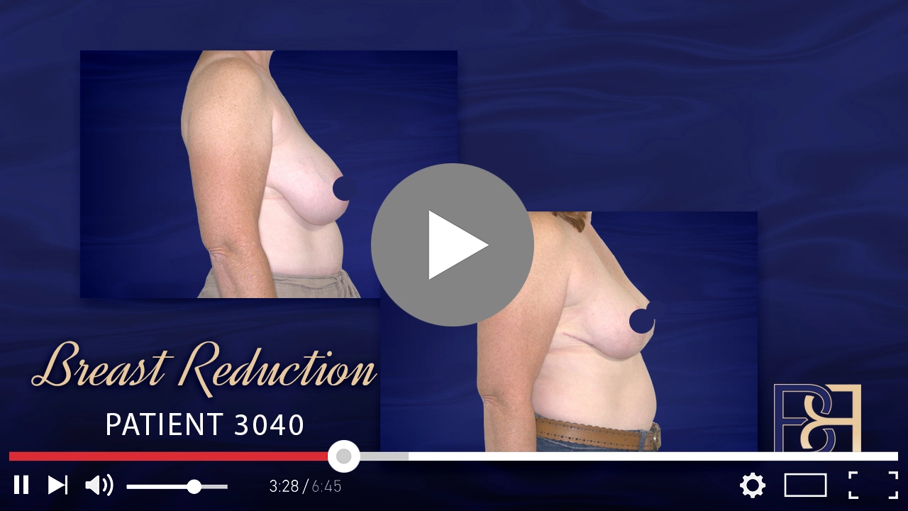 Patient 3040 - Breast Reduction - Featured Image
