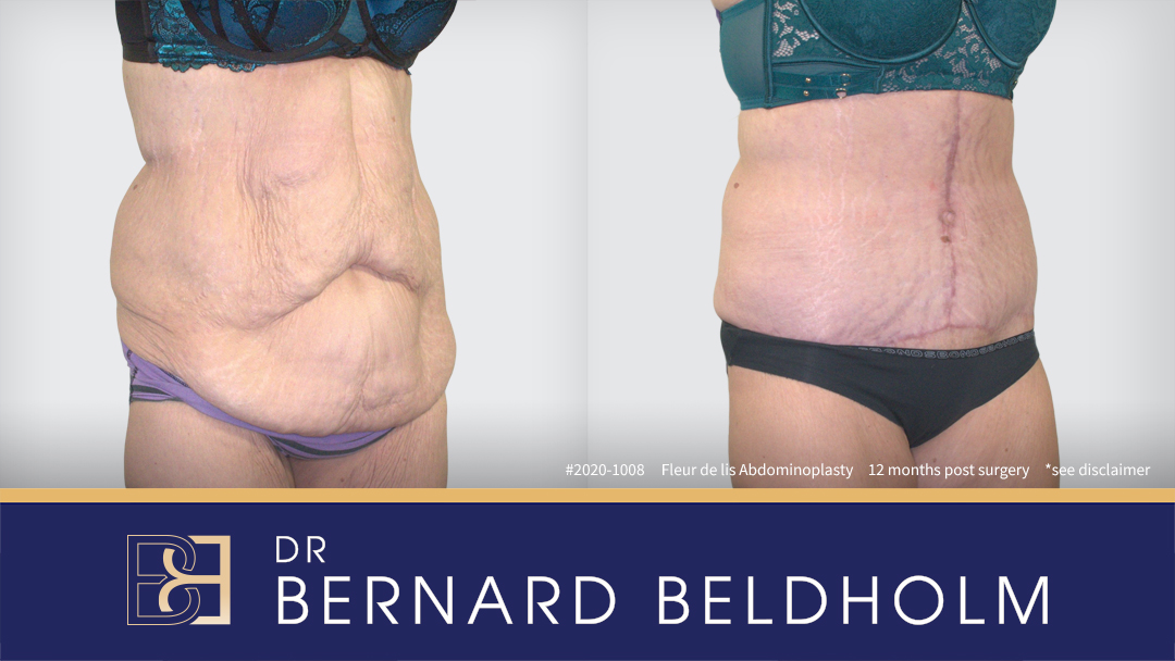 Fleur de lis abdominoplasty after extensive weight loss | Dr Bernard Beldholm