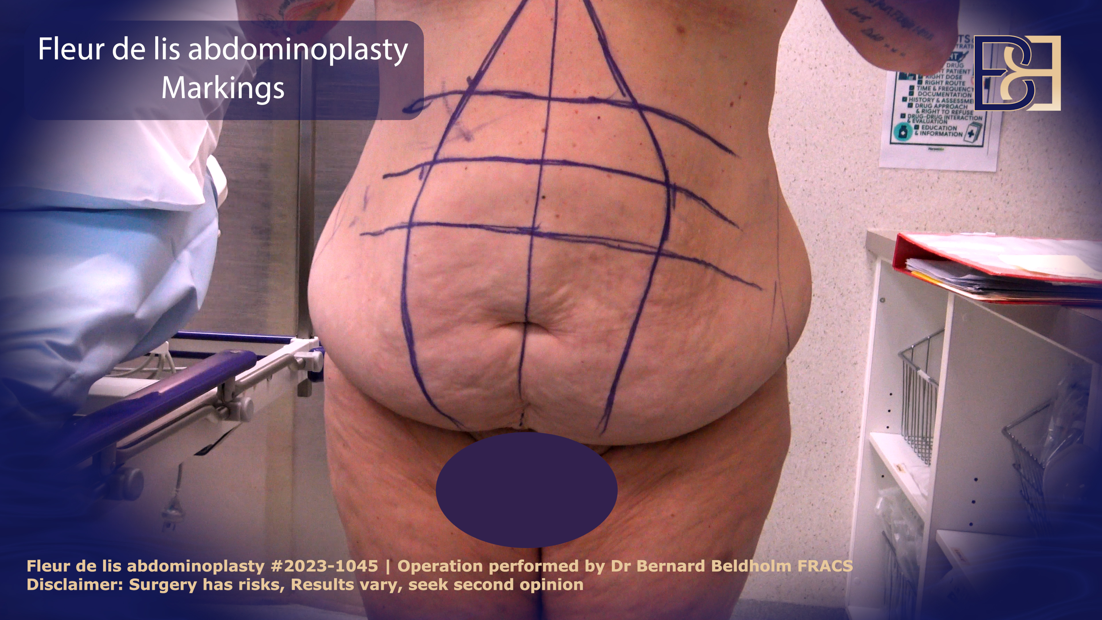 Fleur de lis abdominoplasty markings | Dr Bernard Beldholm