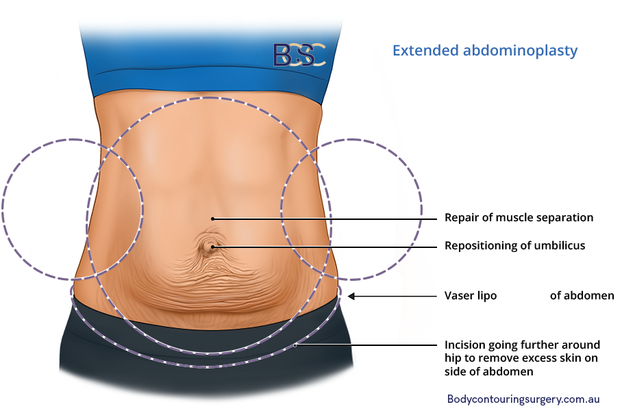 Extended abdominoplasty | Dr Bernard Beldholm