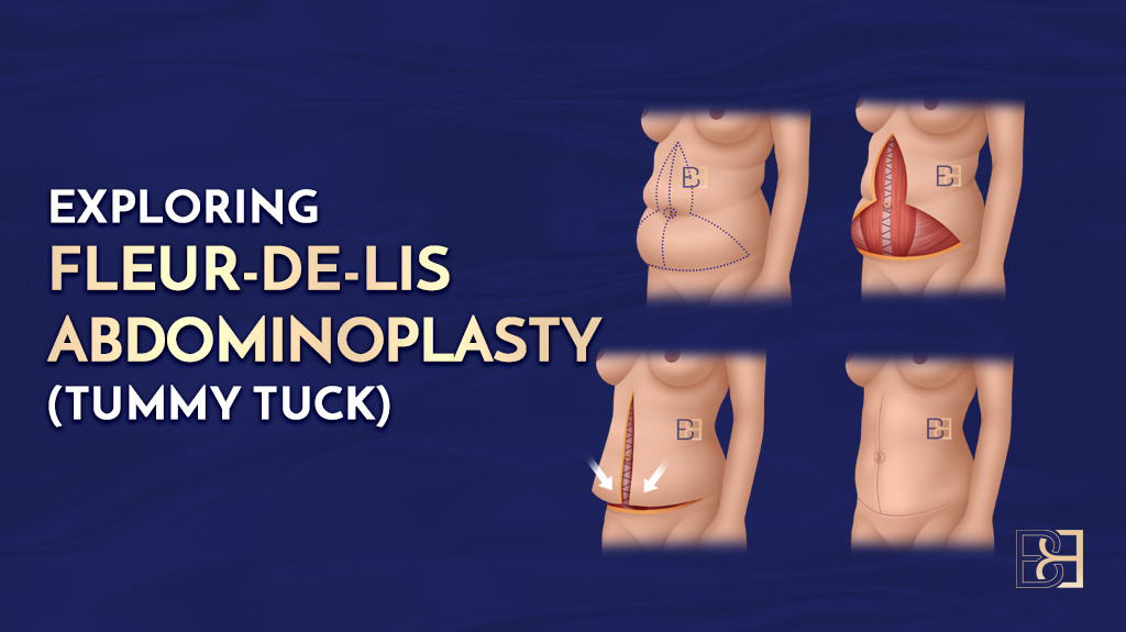 Exploring Fleur-de-Lis Abdominoplasty (Tummy Tuck)