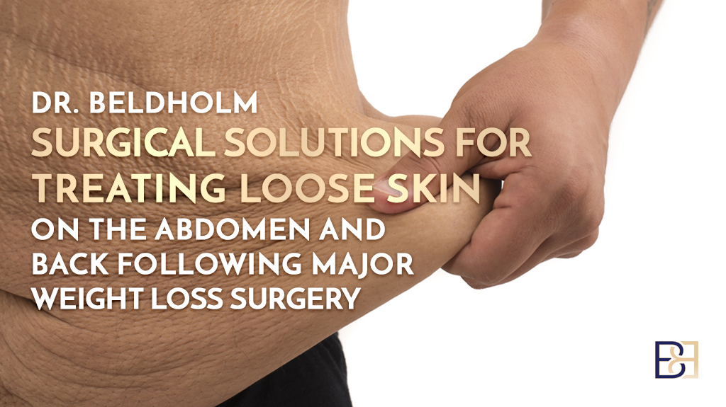 Dr. Beldholm Surgical Solutions for Treating Loose Skin on the Abdomen and Back Following Major Weight Loss Surgery