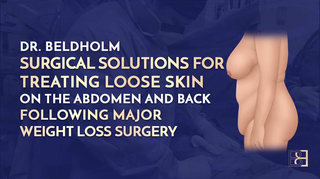 Dr. Beldholm Surgical Solutions for Treating Loose Skin on the Abdomen and Back Following Major Weight Loss Surgery