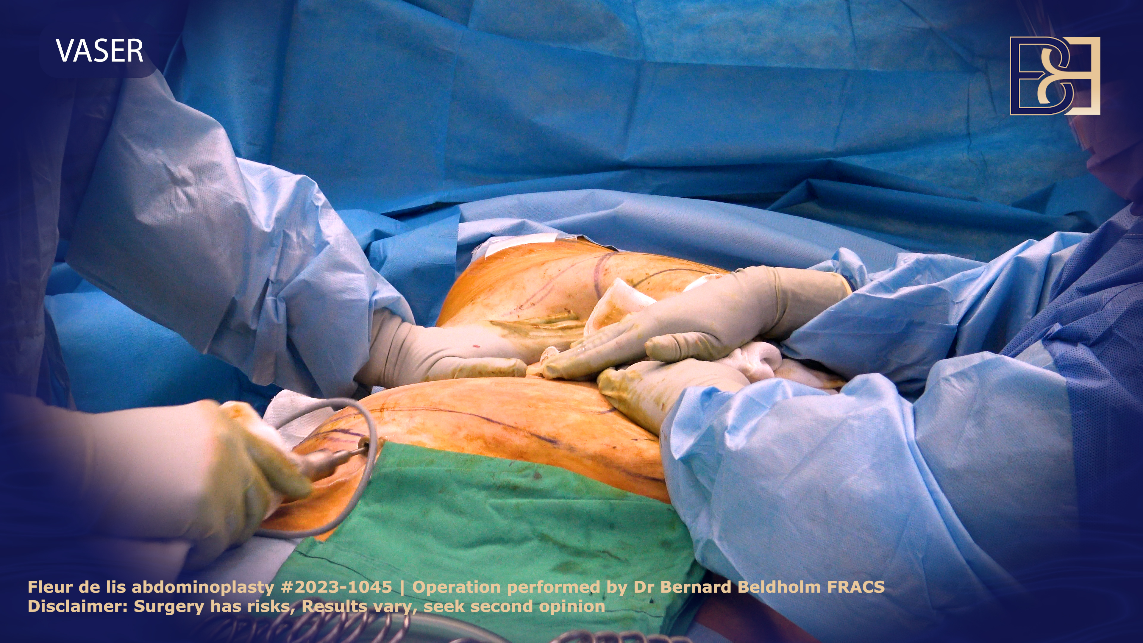 Dr Bernard Beldholm performing VASER liposuction as part of Fleur de lis abdominoplasty
