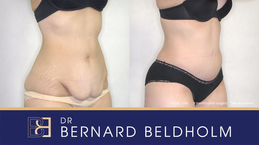 Abdominoplasty after massive weight loss | Dr Bernard Beldholm