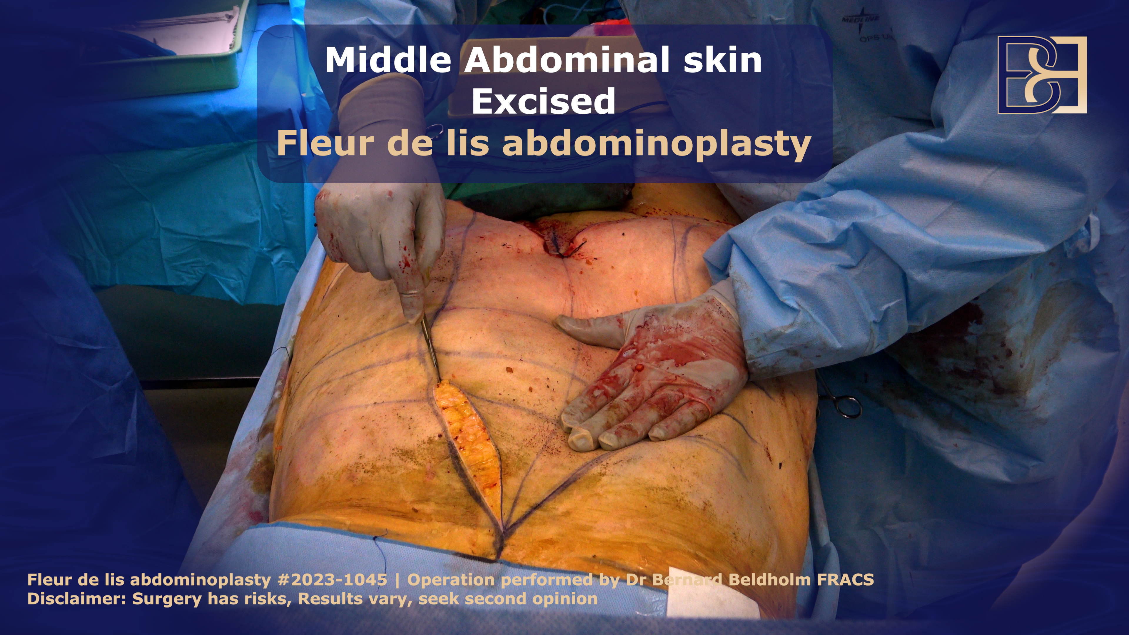 Removing loose skin in FDL surgery