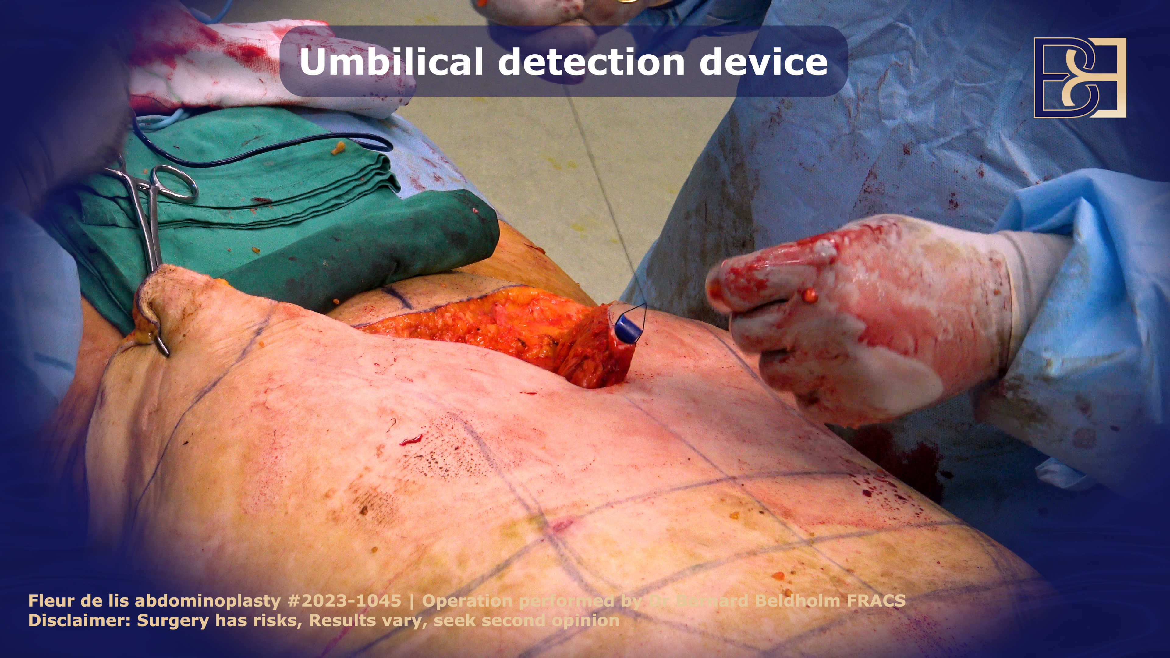 Umbilical detection device | beldholm.com.au