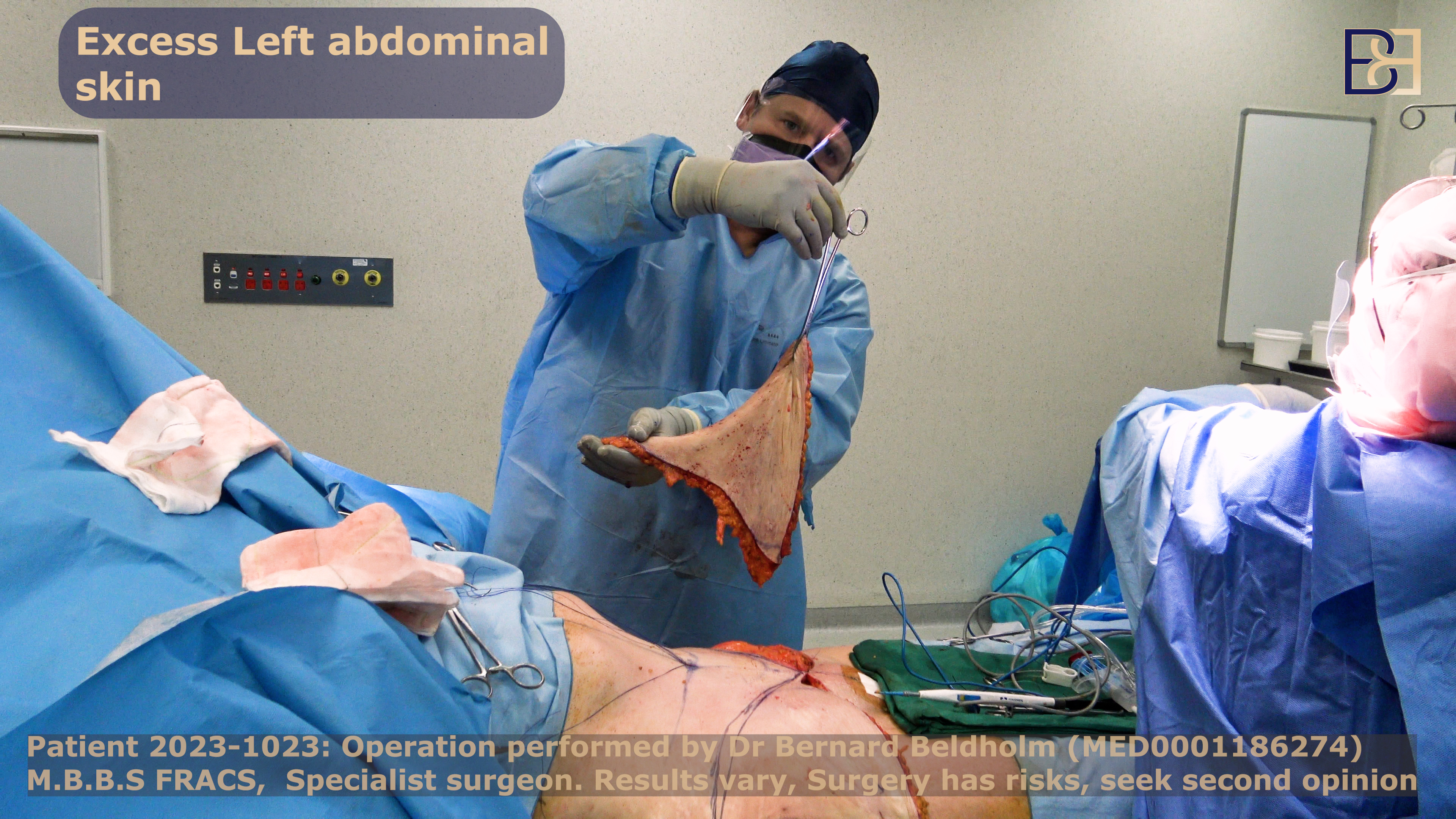 Dr Beldholm removes excess skin as part of an abdominoplasty