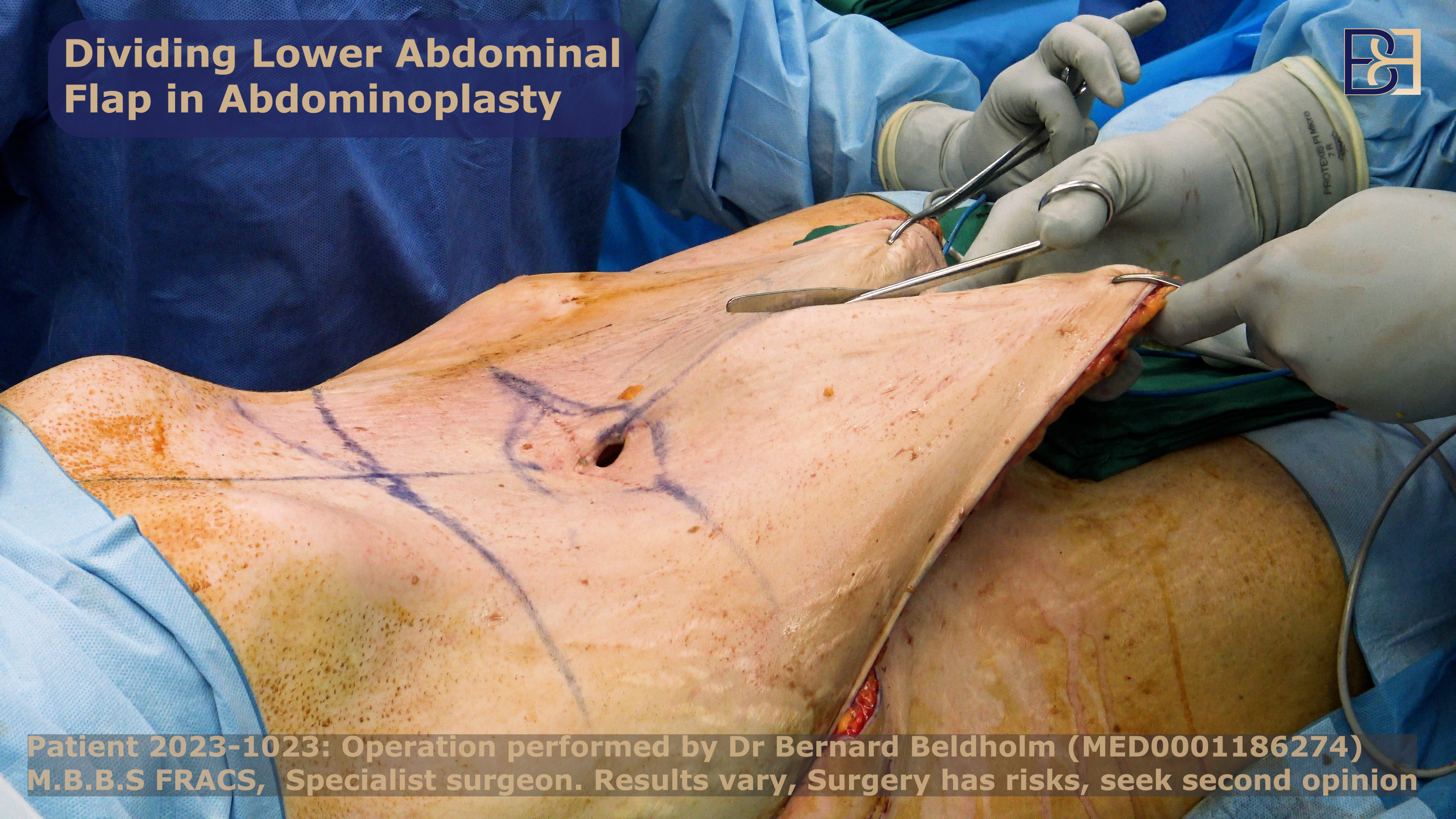 Surgeon removes excess skin and underlying tissue during abdominoplasty procedures