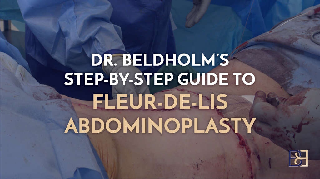 Dr. Beldholm’s Step-by-Step Guide to Fleur-de-Lis Abdominoplasty