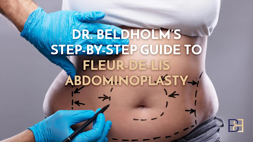 Dr. Beldholm’s Step-by-Step Guide to Fleur-de-Lis Abdominoplasty