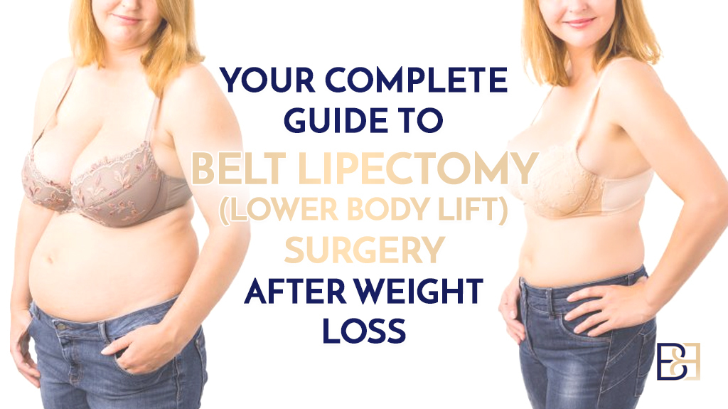 Your Complete Guide to Belt Lipectomy (Lower Body Lift) Surgery After Weight Loss
