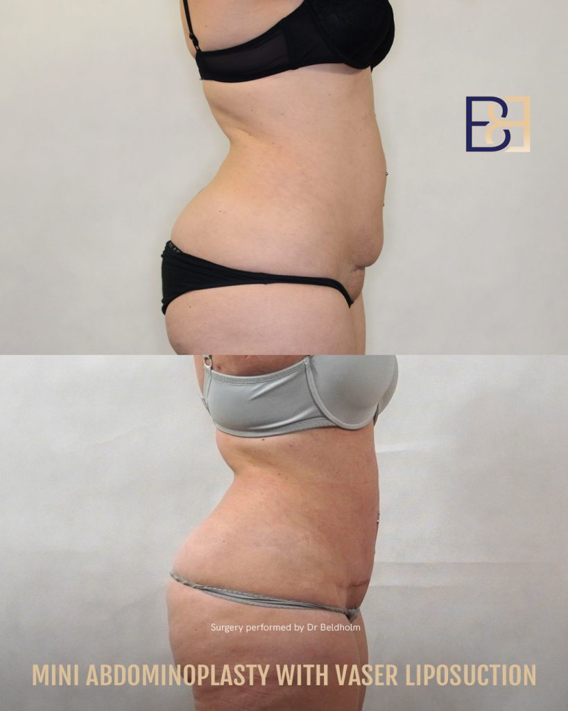 DrBB IG image Patient 2022 1019 Mini Abdominoplasty with VASER 3