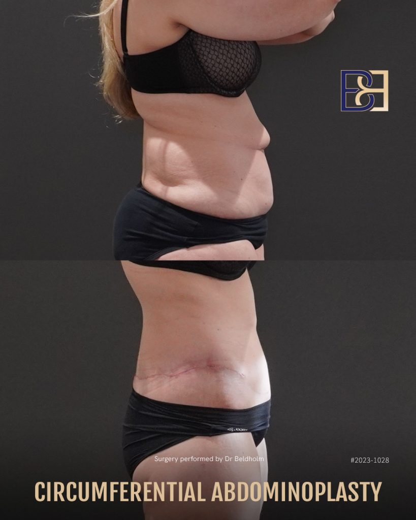 Ask Dr. Beldholm: What's the Difference Between Belt Lipectomy and Abdominoplasty Surgery? 10 DrBB IG image Patient 2023 1028 Circumferential Abdominoplasty Slide 3