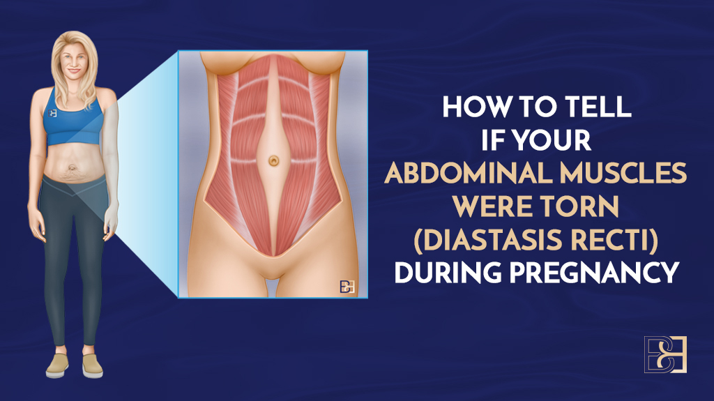 How to Tell if Your Abdominal Muscles Were Torn (Diastasis Recti) During Pregnancy