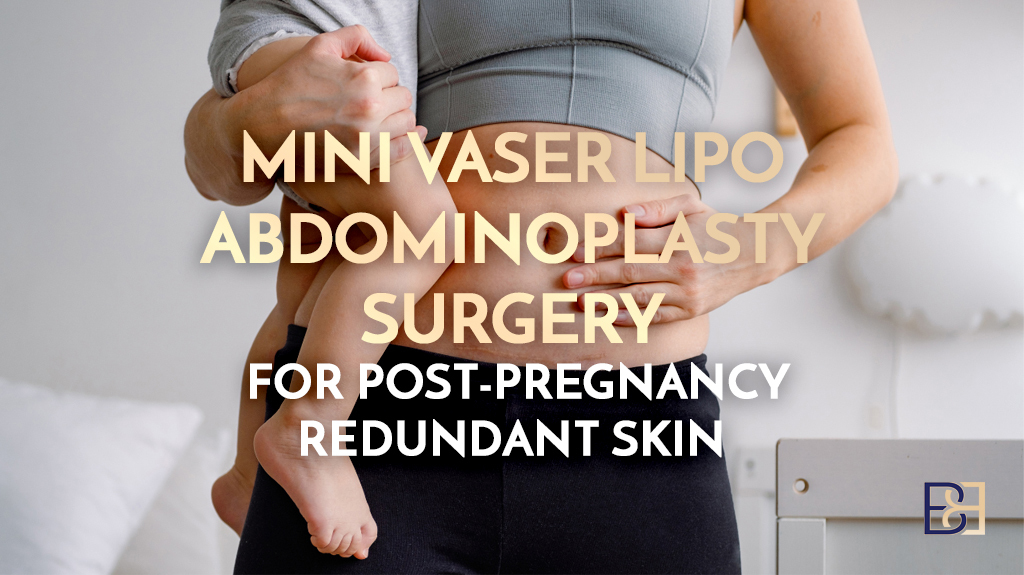 Mini VASER Lipo-Abdominoplasty Surgery for Post-Pregnancy Redundant Skin
