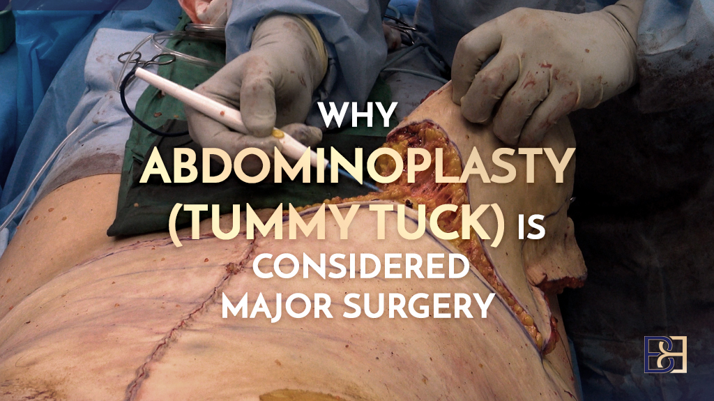 Why Abdominoplasty (Tummy Tuck) is Considered Major Surgery