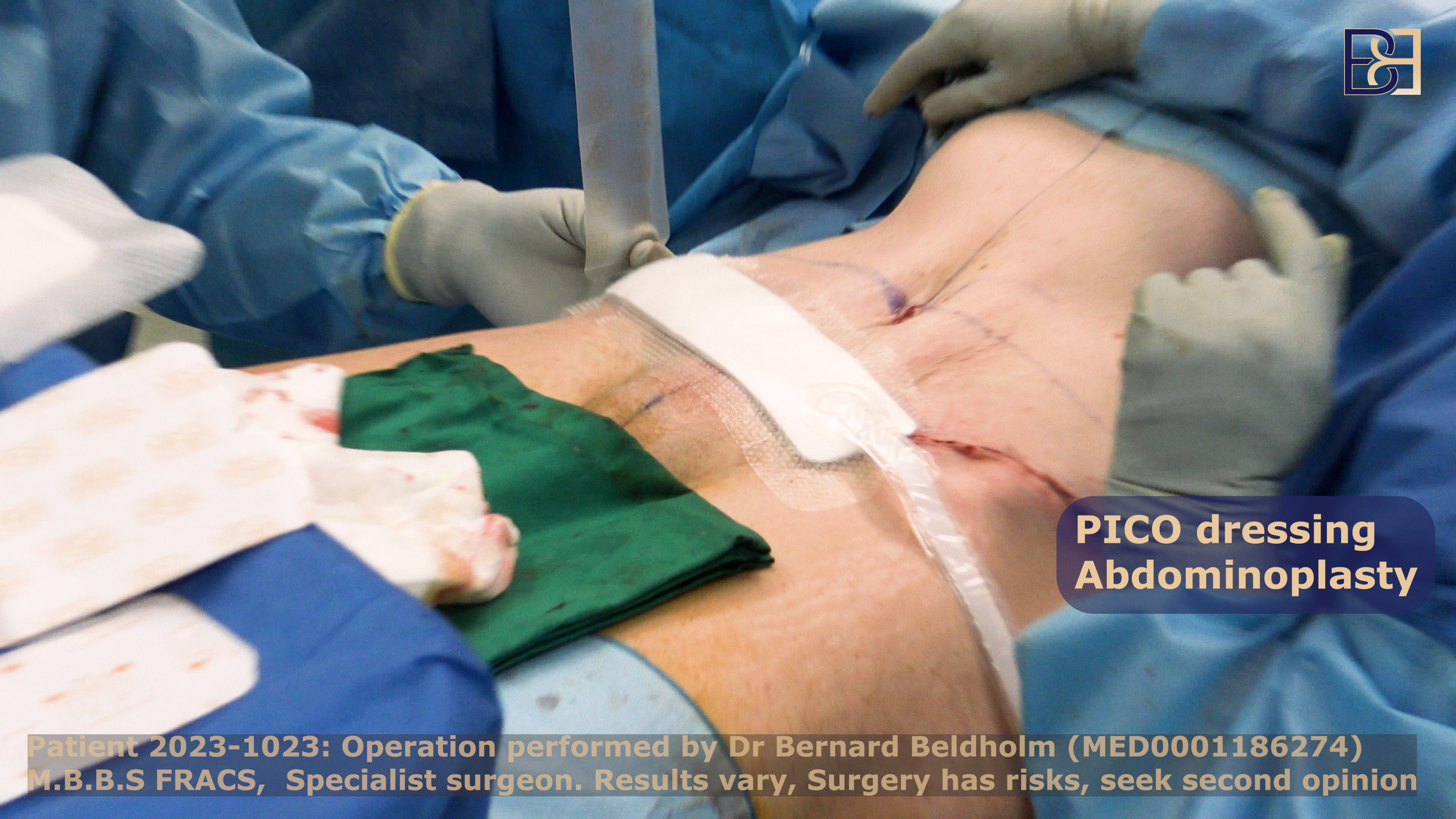 PICO Negative Pressure Wound Therapy used by Dr Beldholm during Fleur-de-lis abdominoplasty (tummy tuck)m