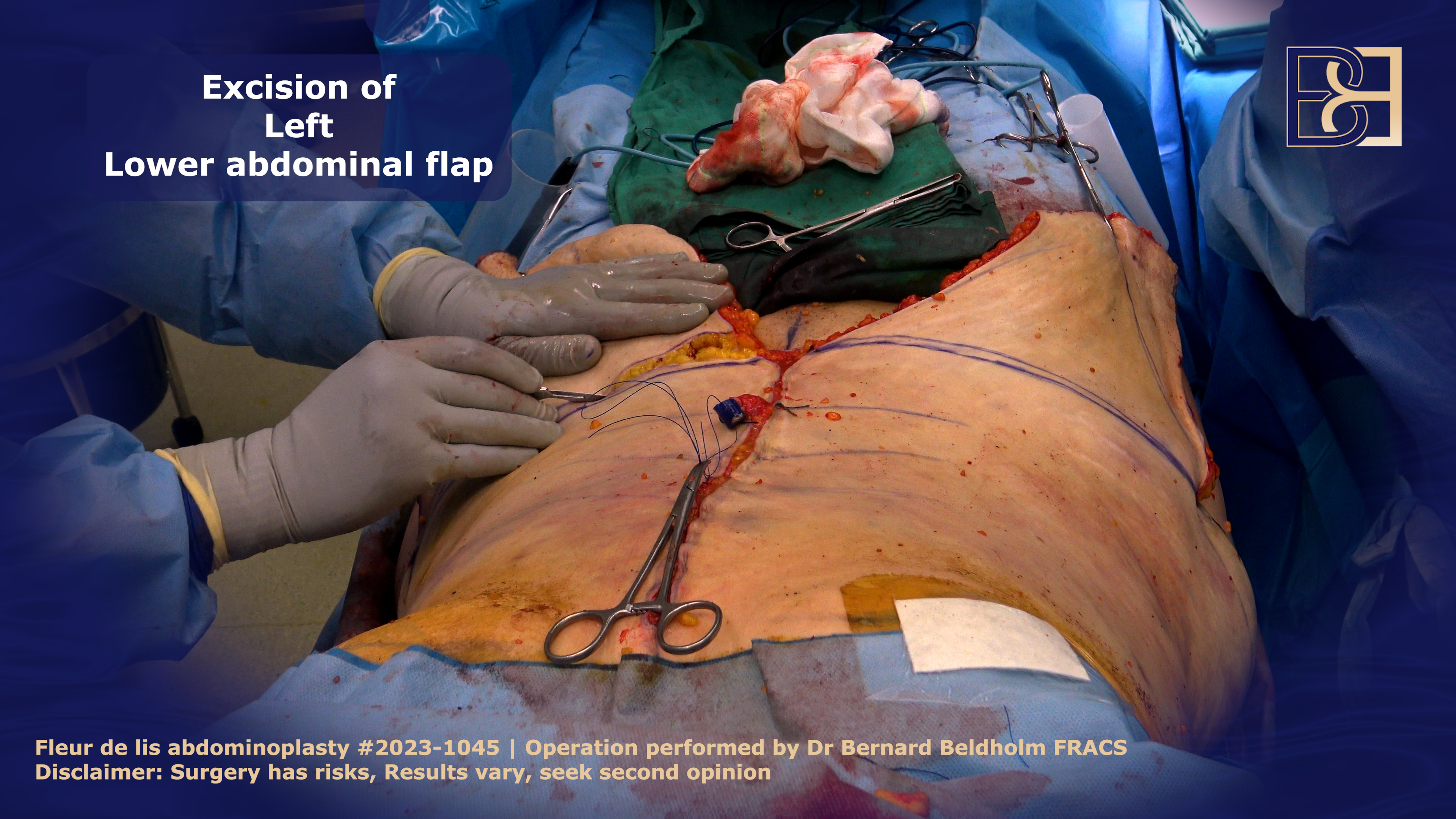 Excision of left lower abdominal flap in Fleur de lis abdominoplasty performed by Dr Beldholm