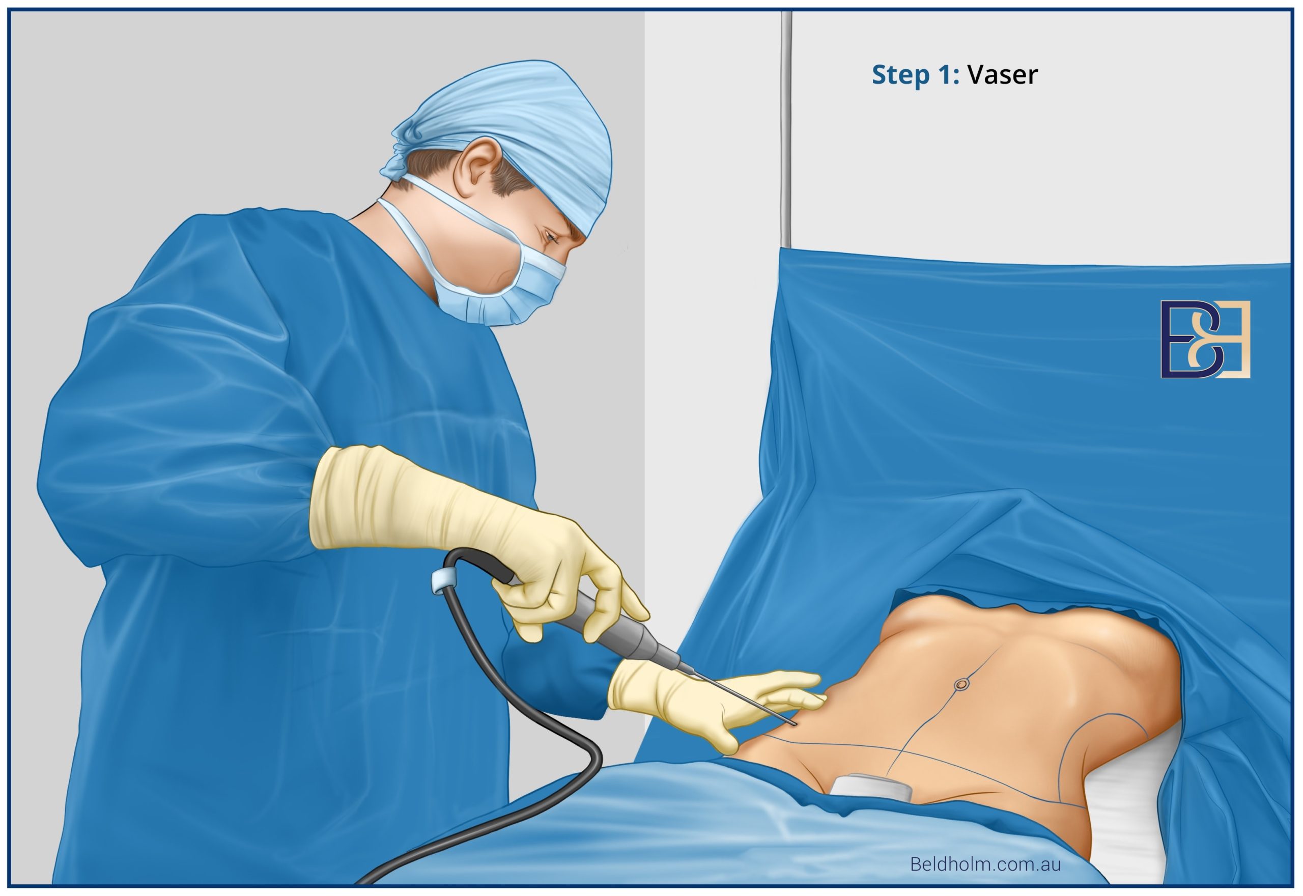 VASER liposuction performed by Dr Beldholm