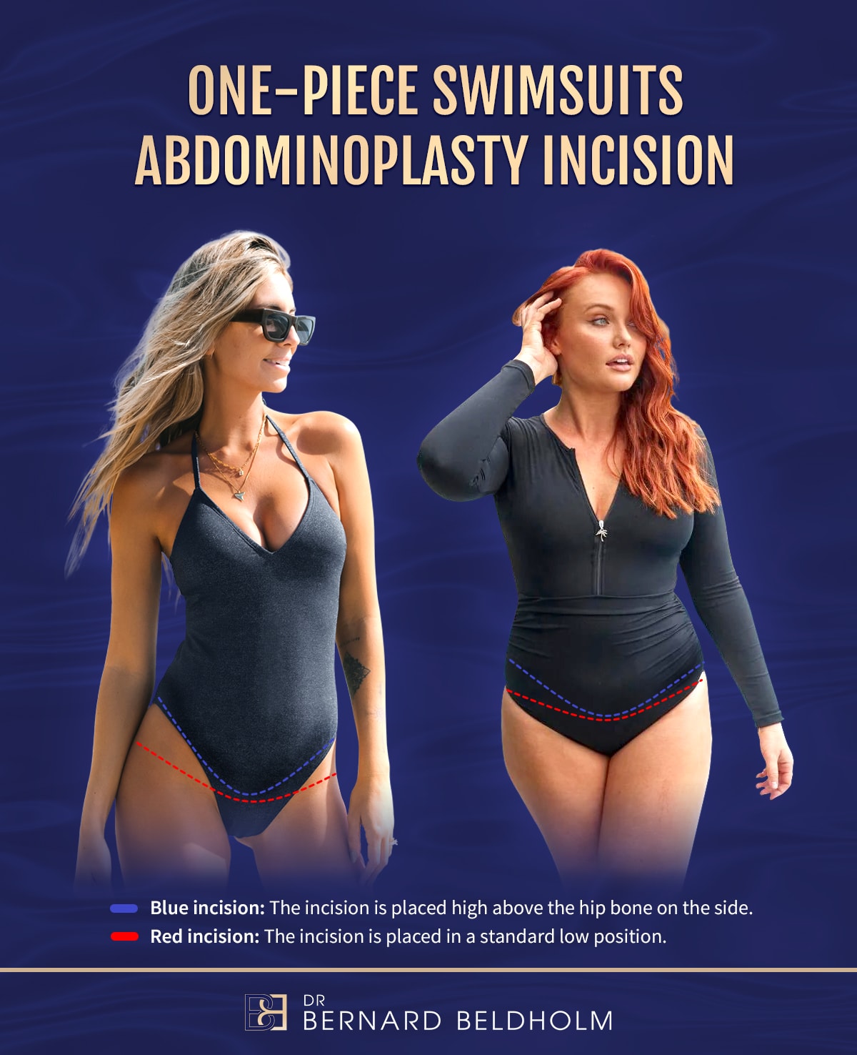 One peice swimsuits and abdominoplasty scar placement