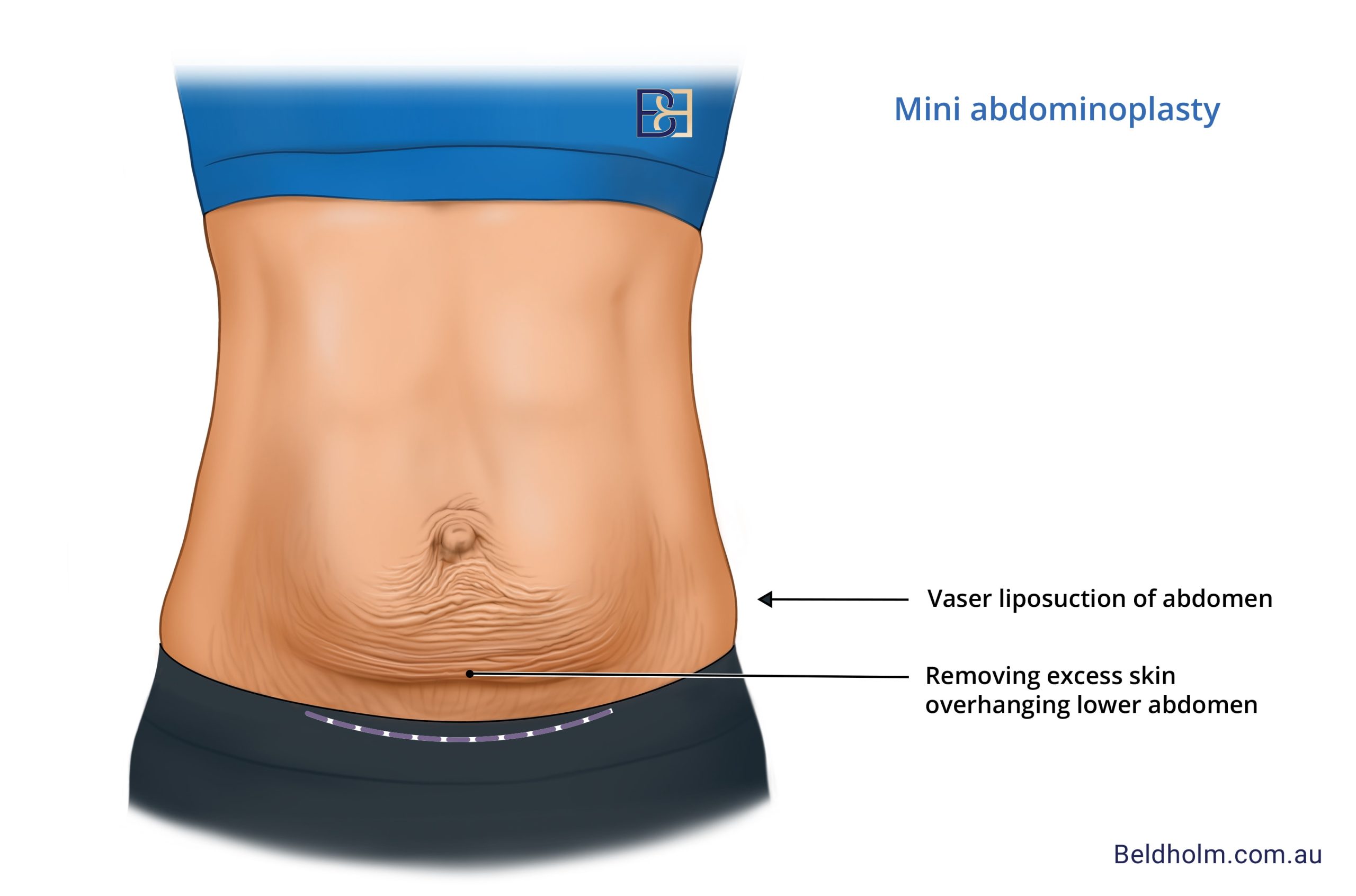 Illustration of Mini Abdominoplasty | Dr Beldholm