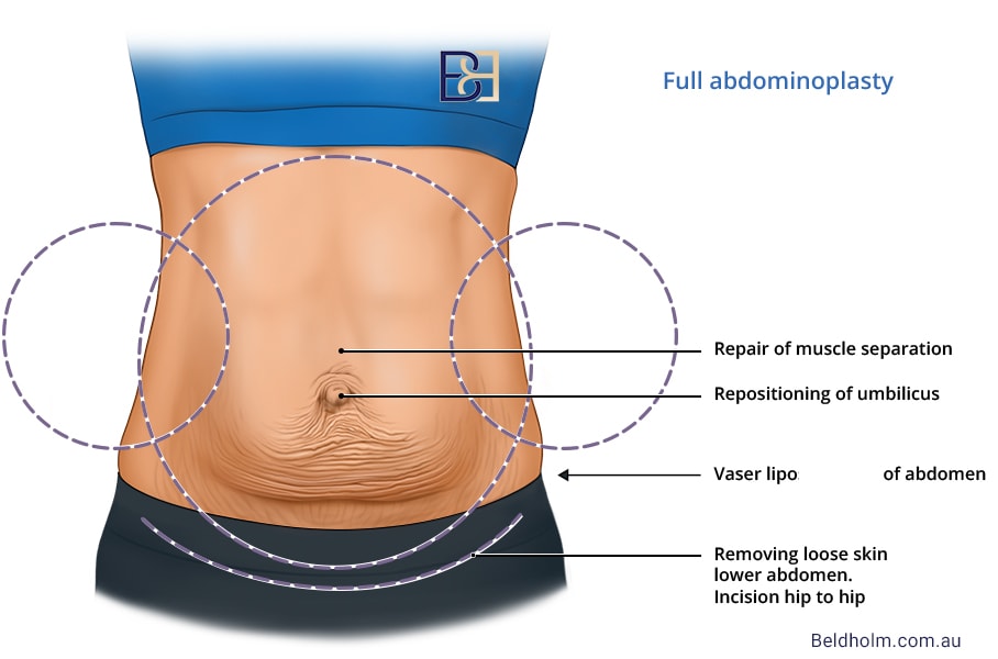 Illustration of Full abdominoplasty | Dr Beldholm