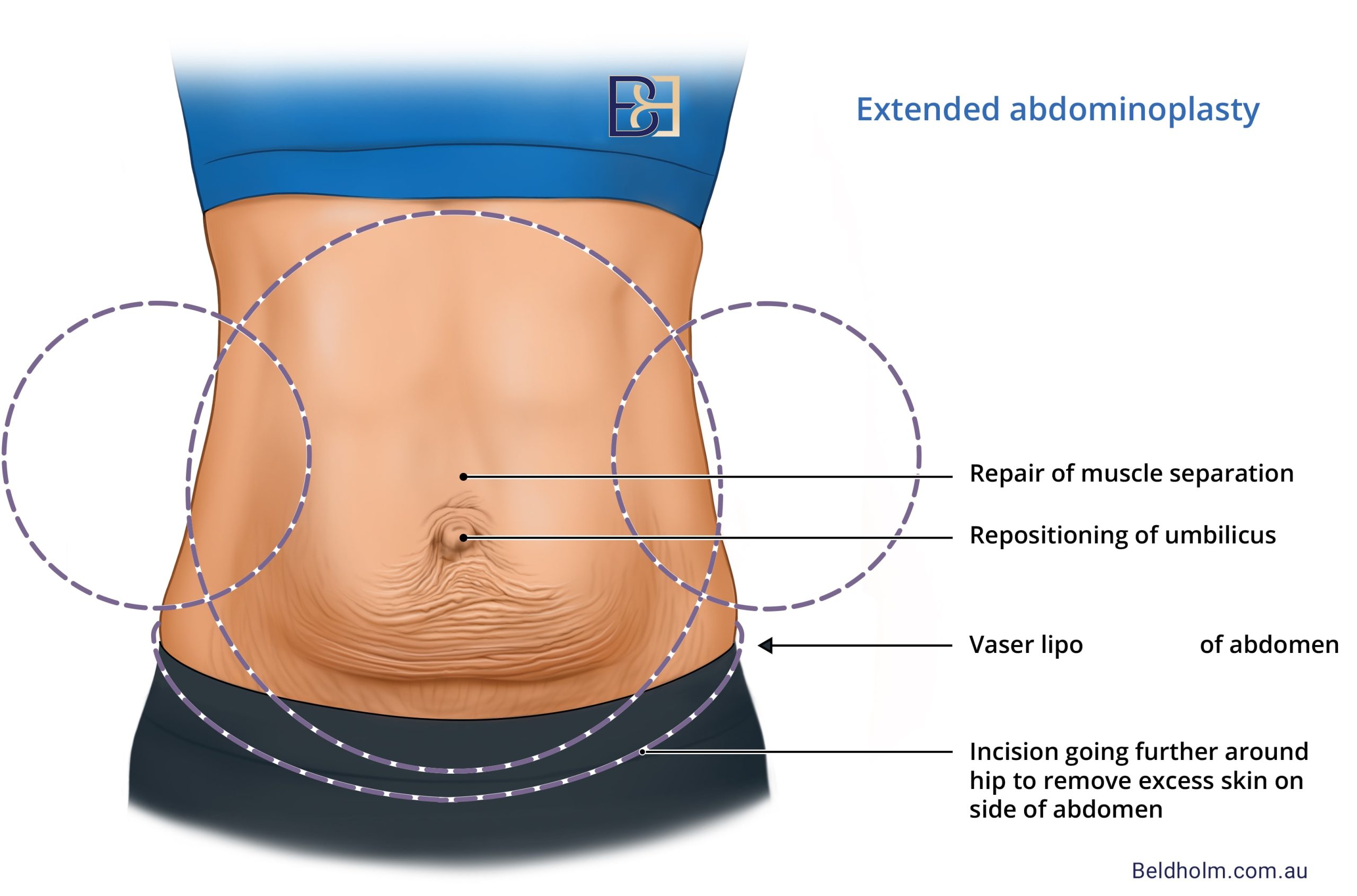 Illustration of extended abdominoplasty | Dr Beldholm