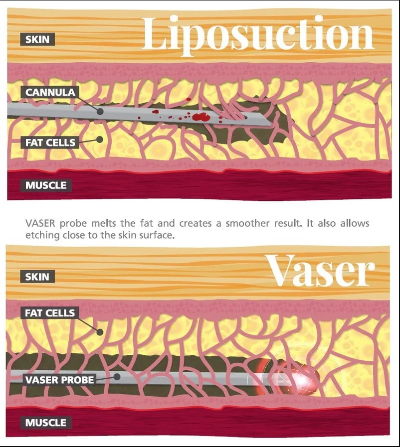 VASER liposuction vs Standard liposuction