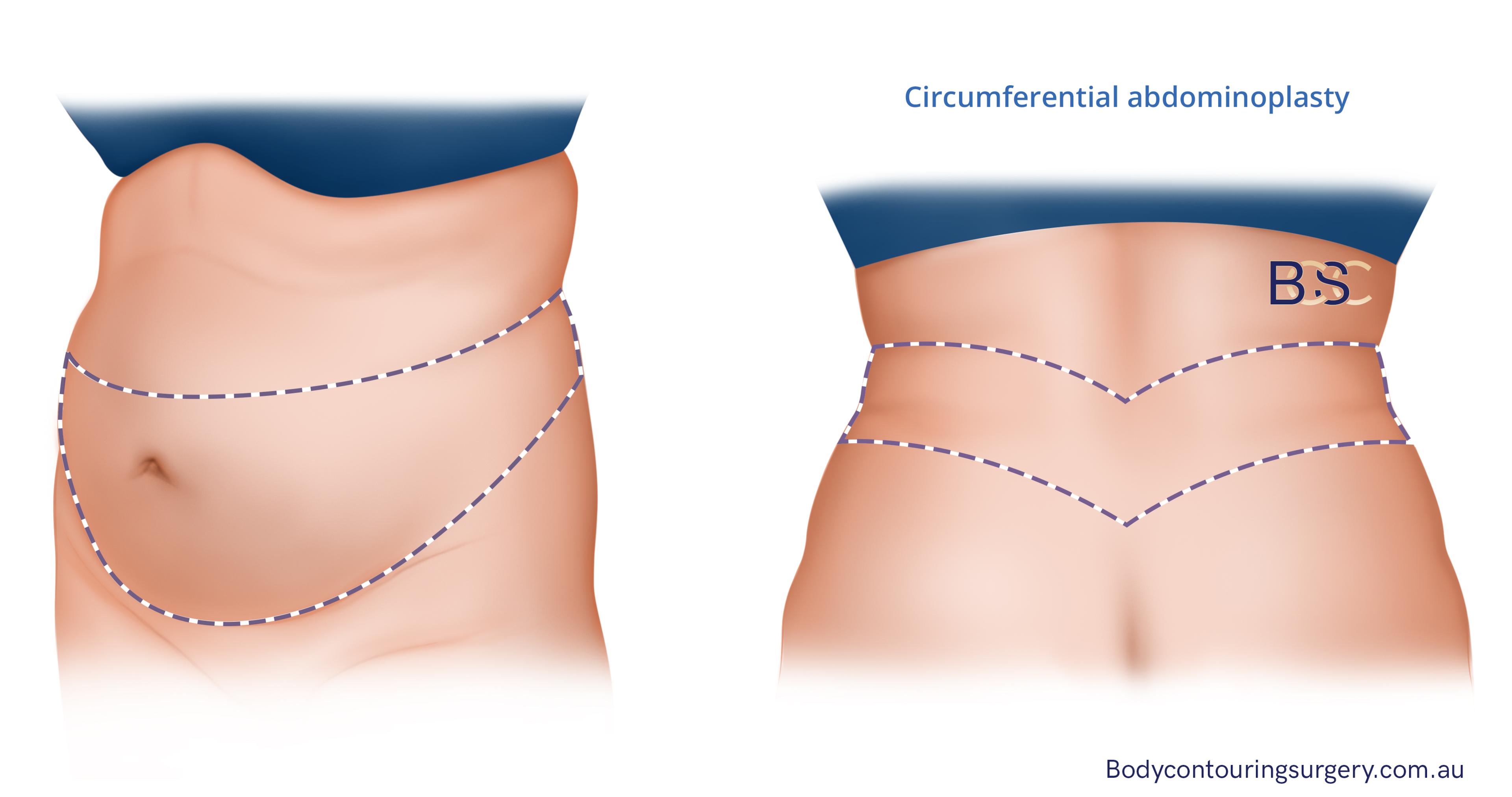 Illustration of belt lipectomy | Dr Beldholm