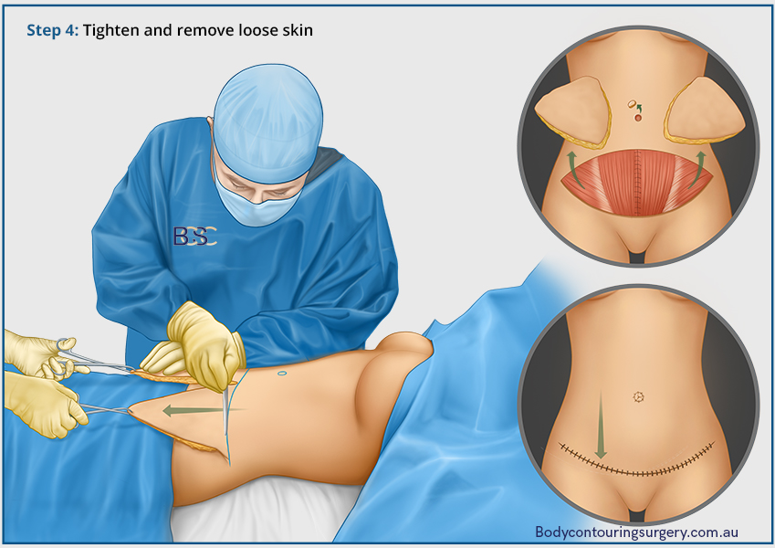 Illustration of removing excess skin in Abdominoplasty surgery by Dr Beldholm