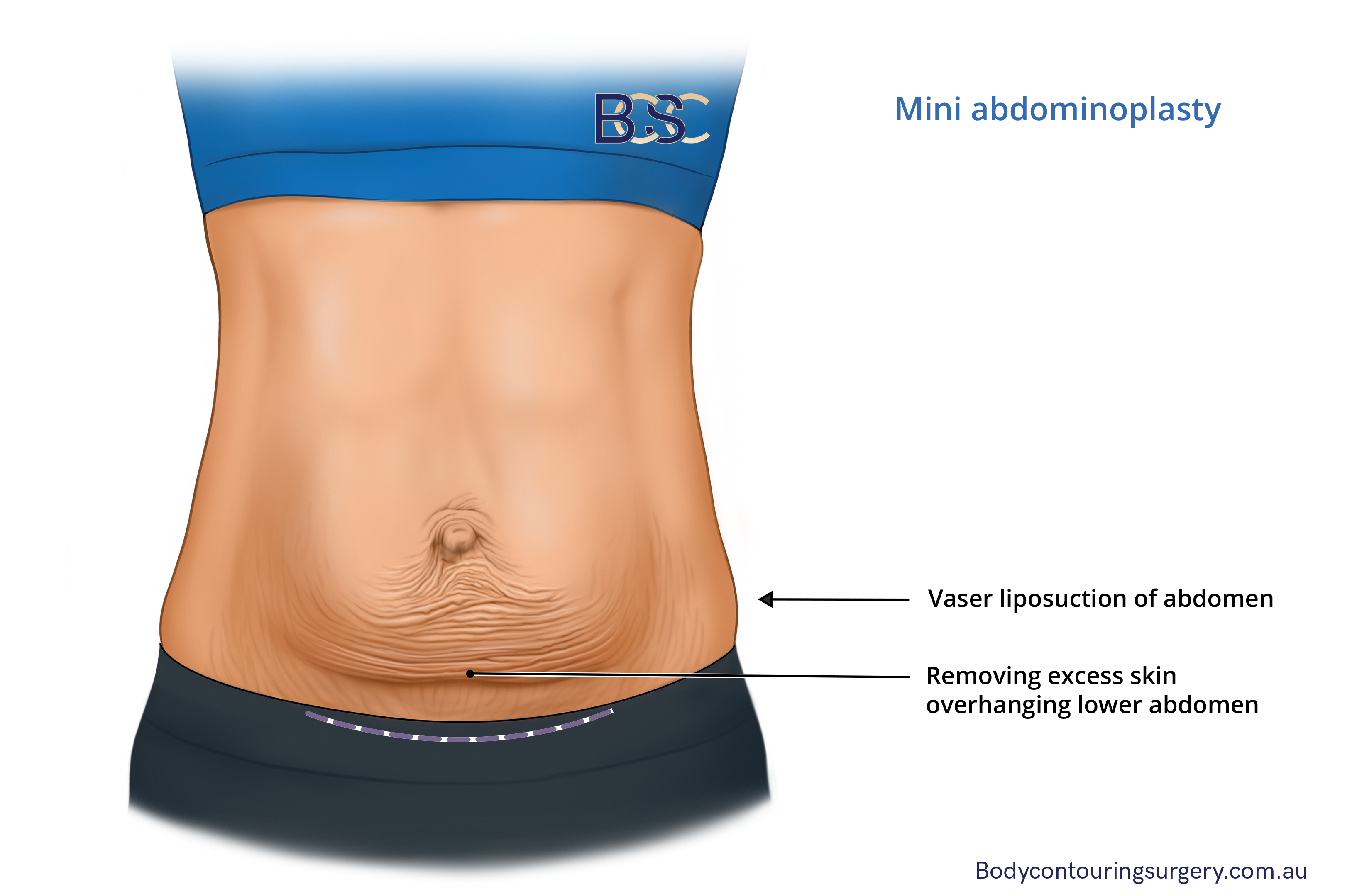 Mini tummy tuck procedure involves the removal of a minimal amount of redundant skin from the lower abdomen