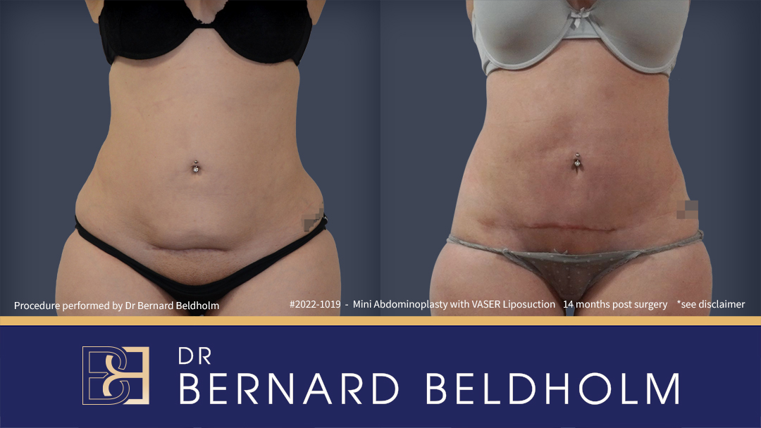 Mini abdominoplasty with VASER Liposuction performed by Dr Beldholm